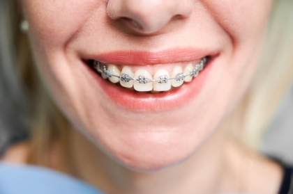Aparaty ortodontyczne: Rodzaje i zastosowanie